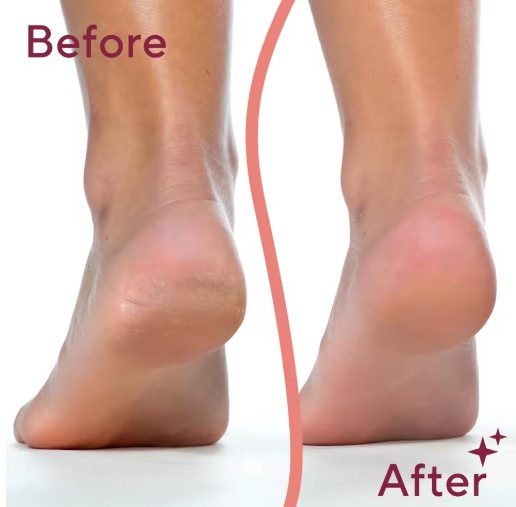 Removedor de callos eléctrico para pies